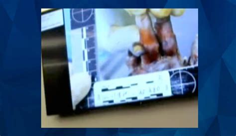 gannon stauch autopsy|Medical examiner reviews Gannon’s injuries in。